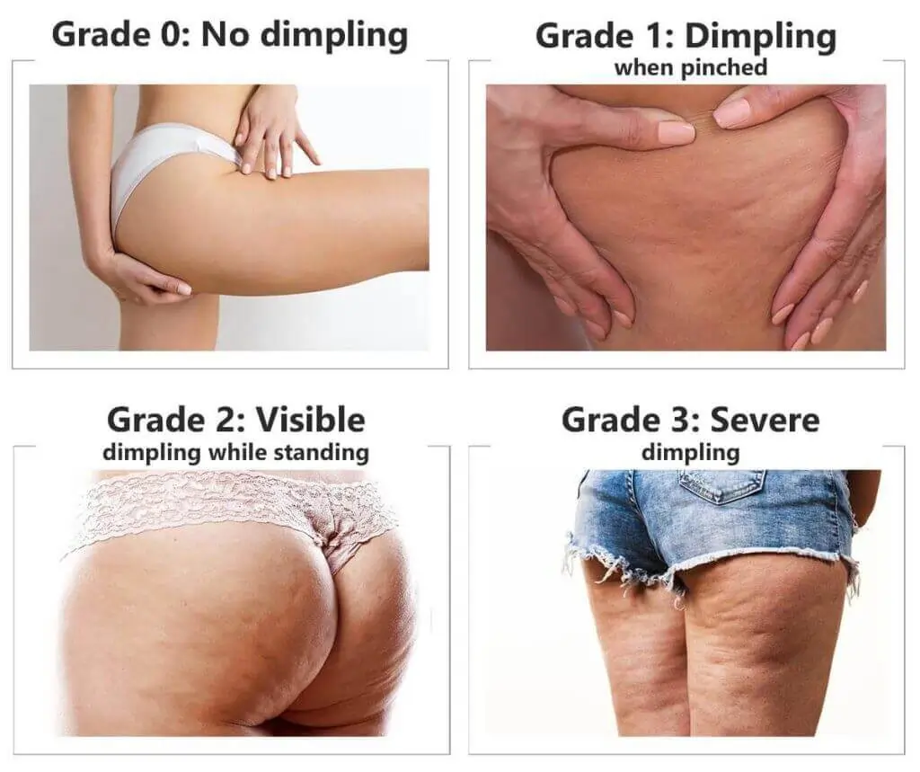 Representation of the stages of cellulite development Thames Ditton